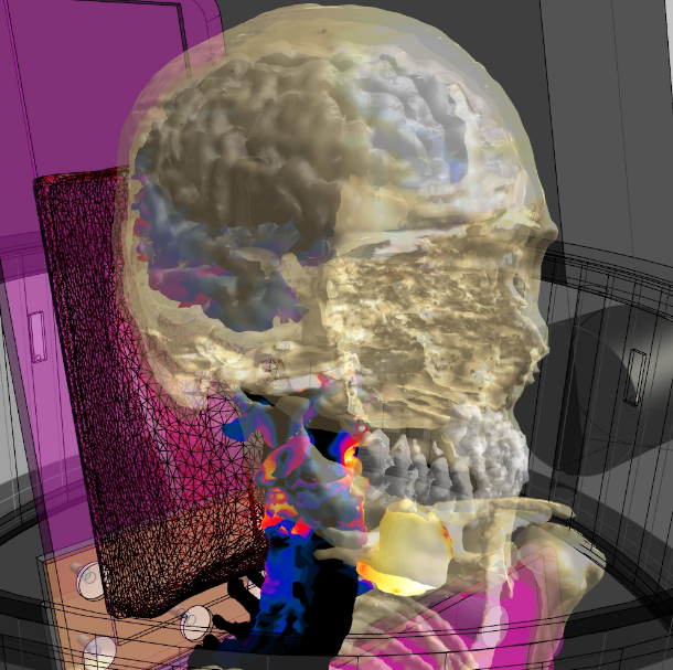 Image showing P-THERMAL solver applied to human head and neck model